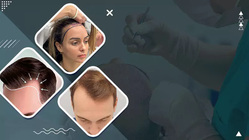 hair transplant